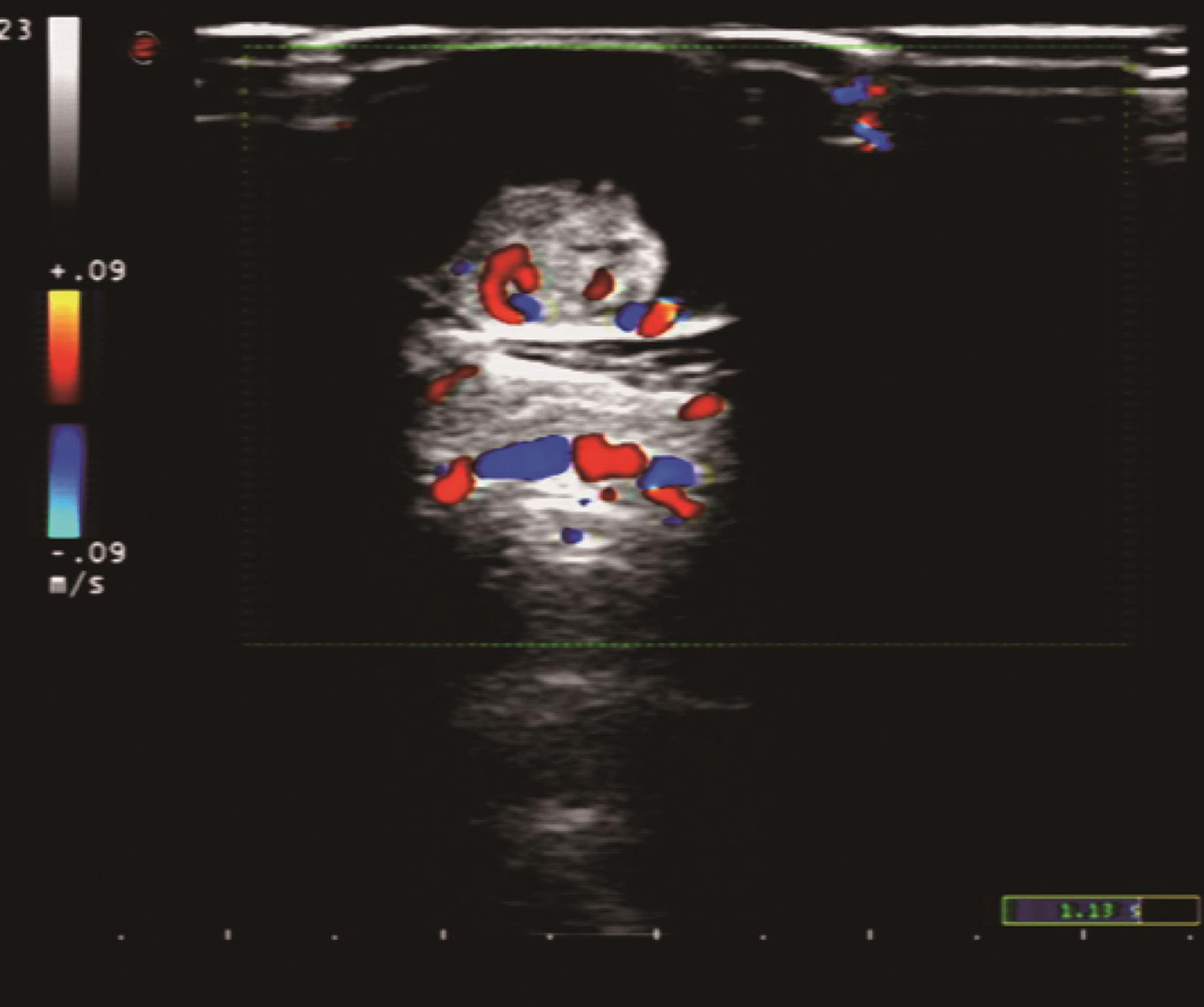 /uploads/image/2025-05-26/160229325图1 颈部超声示甲状腺右叶中低回声结节CDFI可见较丰富血流信号.jpg 图1 颈部超声示甲状腺右叶中低回声结节CDFI可见较丰富血流信号